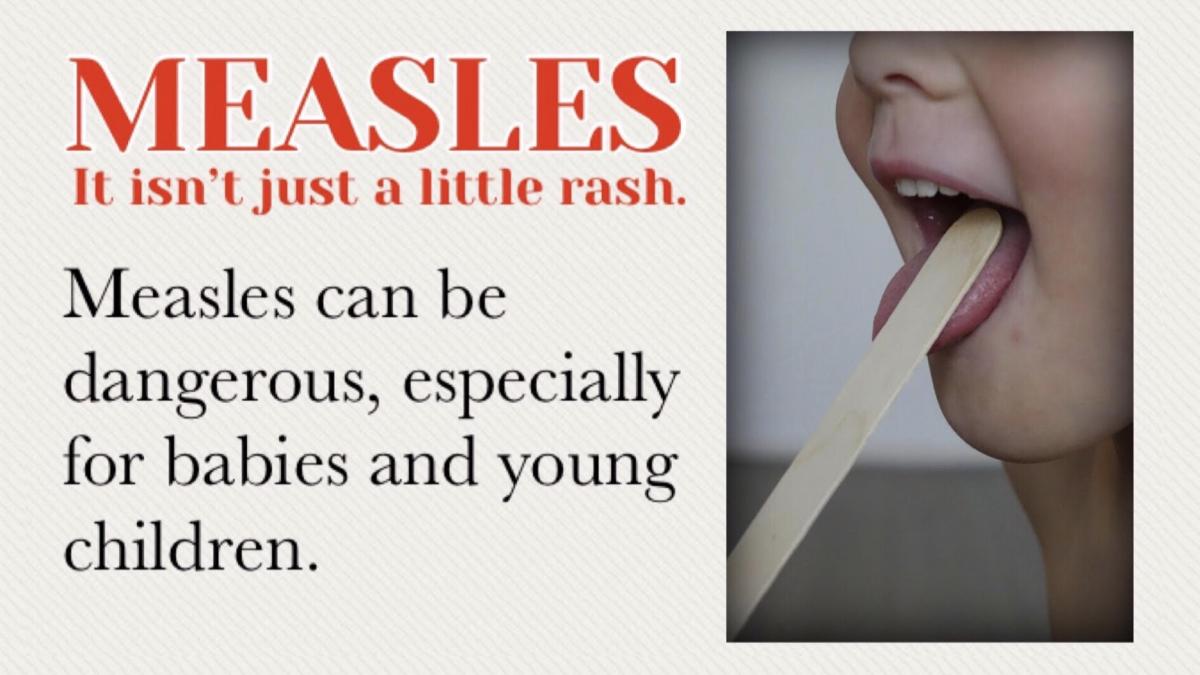 measles - not just a little rash